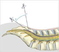 Ilustração ângulos da agulha para curso de anestesia