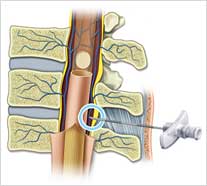 Ilustração medula espinhal e dura mater para curso de anestesia